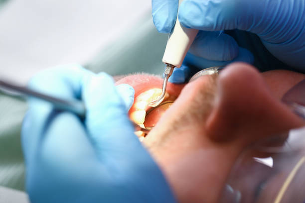 Best Urgent Care for Lost Fillings or Crowns in Springfield, SD