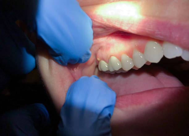 Best Emergency Denture Repair in Springfield, SD