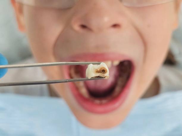 Best Emergency Treatment for Dental Infections or Abscesses in Springfield, SD